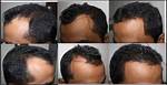 Decoding the 4 Finger Forehead Phenomenon