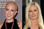 Heidi Montag Before and After Surgery: Navigating the Reality Tv Stars Transformation