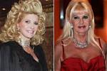 Ivana Trump Plastic Surgery: Before and After