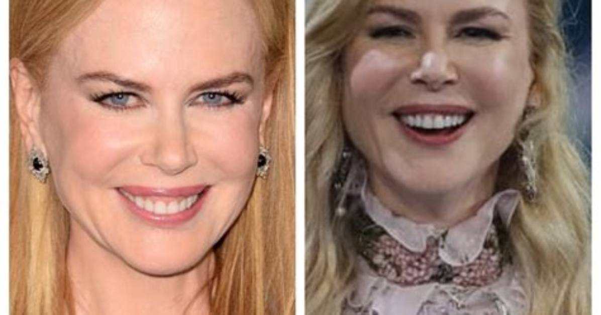 Nicole Kidman and Botox: the Truth Behind Her Ageless Beauty