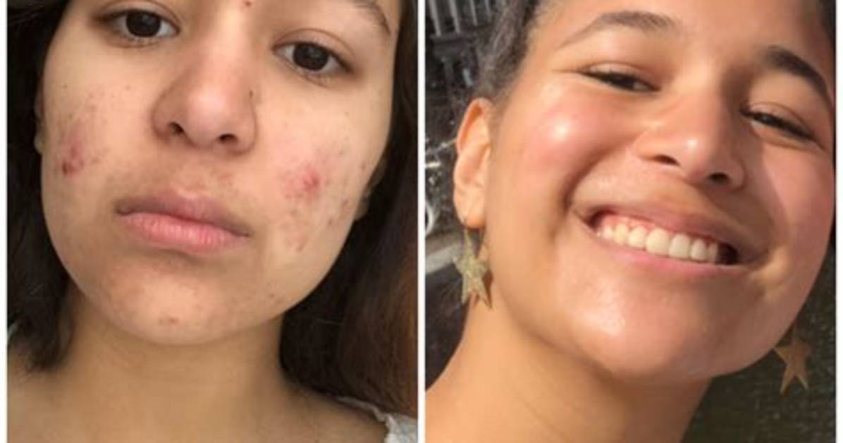 Transformational Journey: Accutane Back Acne Before and After