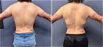Transformative Journeys: Rib Removal Before and After