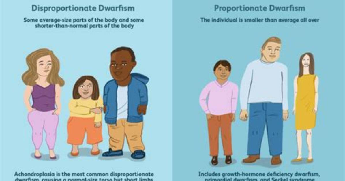 Understanding Dwarfism in Newborns: Causes and Treatment Options